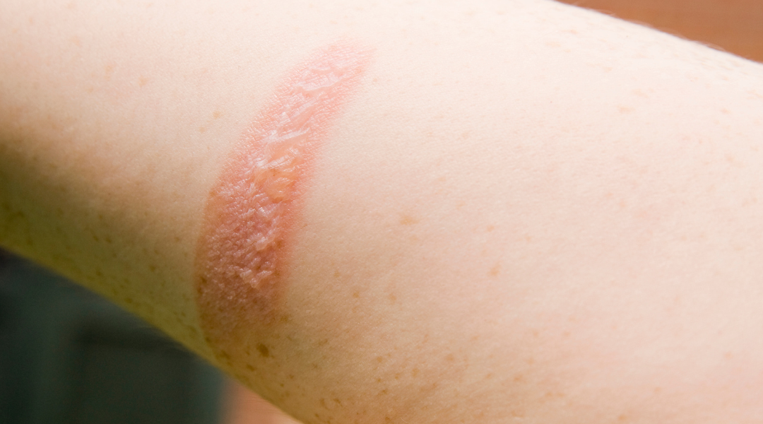 Mejora de lesiones por quemaduras con terapia de oxigenación hiperbárica (TOHB)