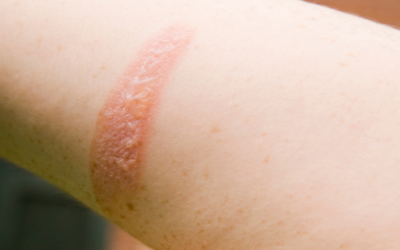 Mejora de lesiones por quemaduras con terapia de oxigenación hiperbárica (TOHB)